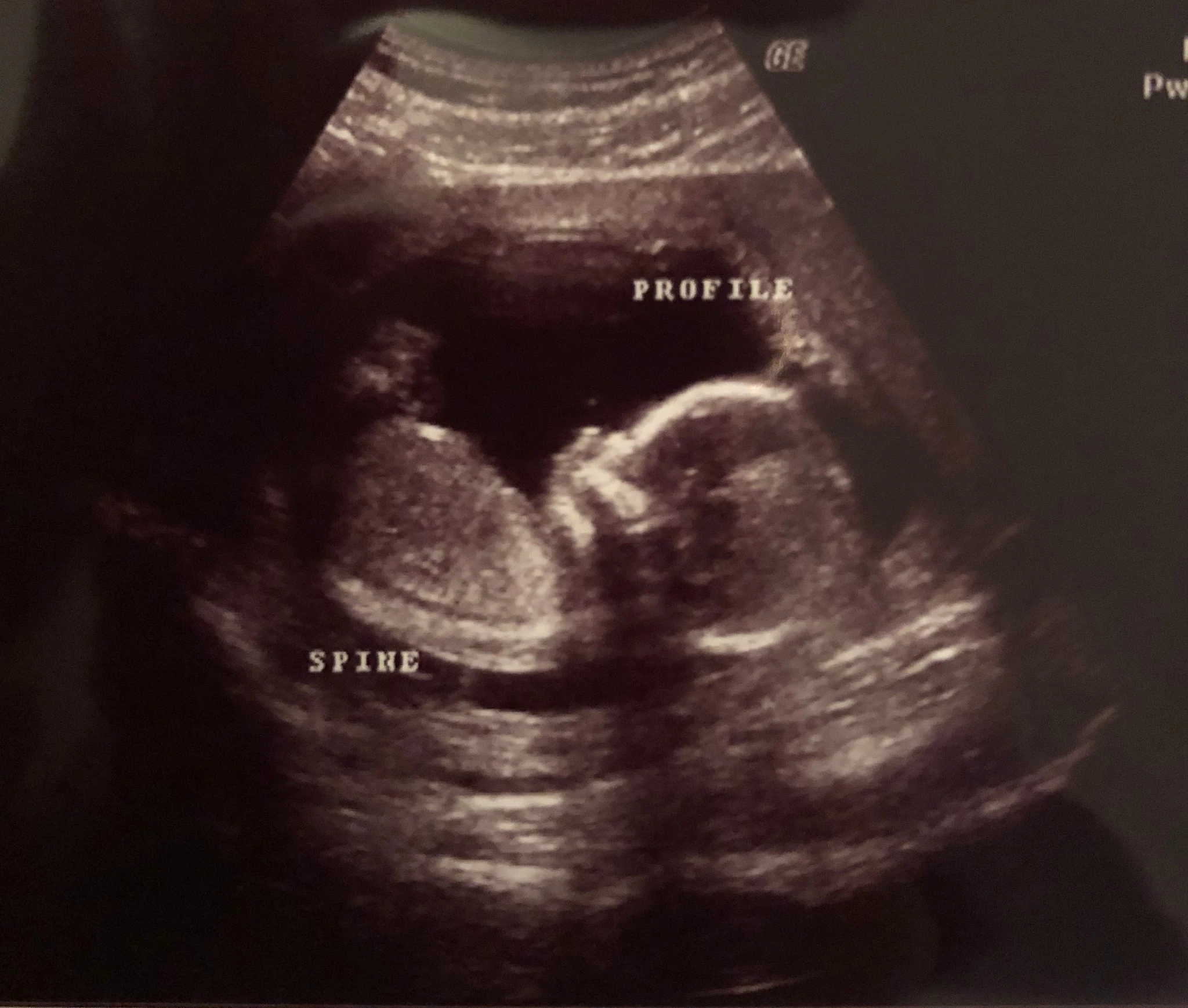 Ultrasound Infant Urn Sign